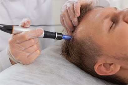 5 procedūros su mezopenu nuo plaukų slinkimo