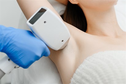 Plaukelių šalinimas lazeriu 