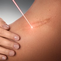 Randelių, kapiliarų, pigmentinių dėmių šalinimas