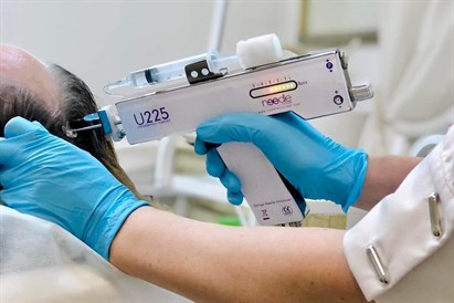 Galvos odos mezoterapija